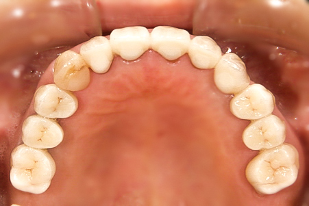 ノンメタル治療後