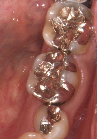 セラミック治療前
