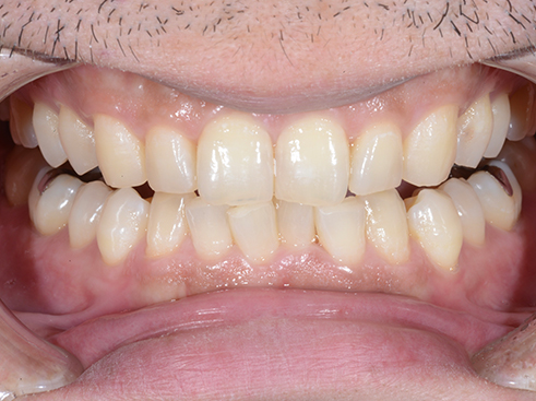 ホームホワイトニング