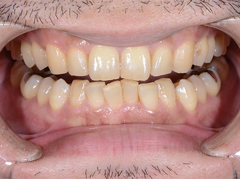 ホームホワイトニング