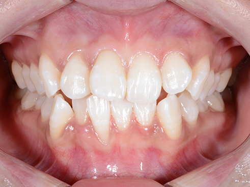 オフィスホワイトニング