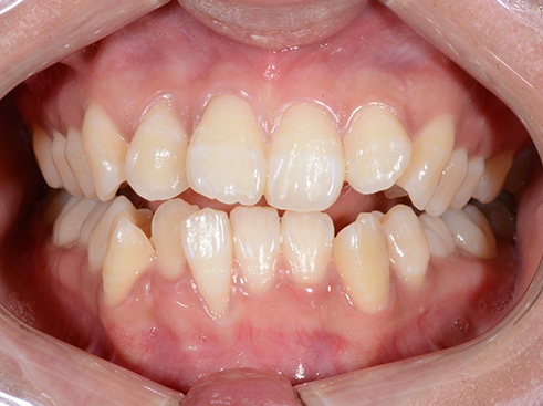 オフィスホワイトニング