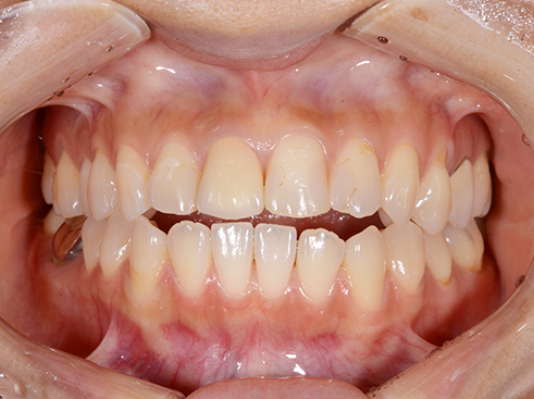 ホームホワイトニング+セラミック治療